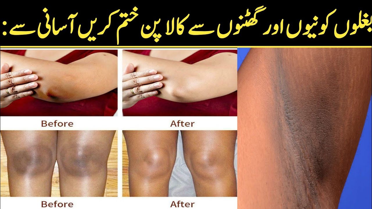 Under Arms Elbow And knees Darkness Remove ✓|| Remedies With Nafeesa
