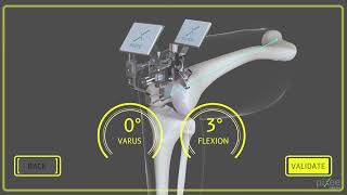 #nevigation #pixee# surgery #knee #kneepain #viralvideo