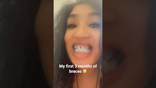 Braces ,under bite and missing teeth journey