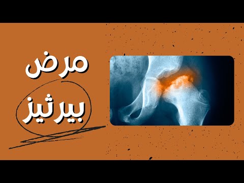 فيديو: هل مرض ليغ بيرثيس وراثي؟