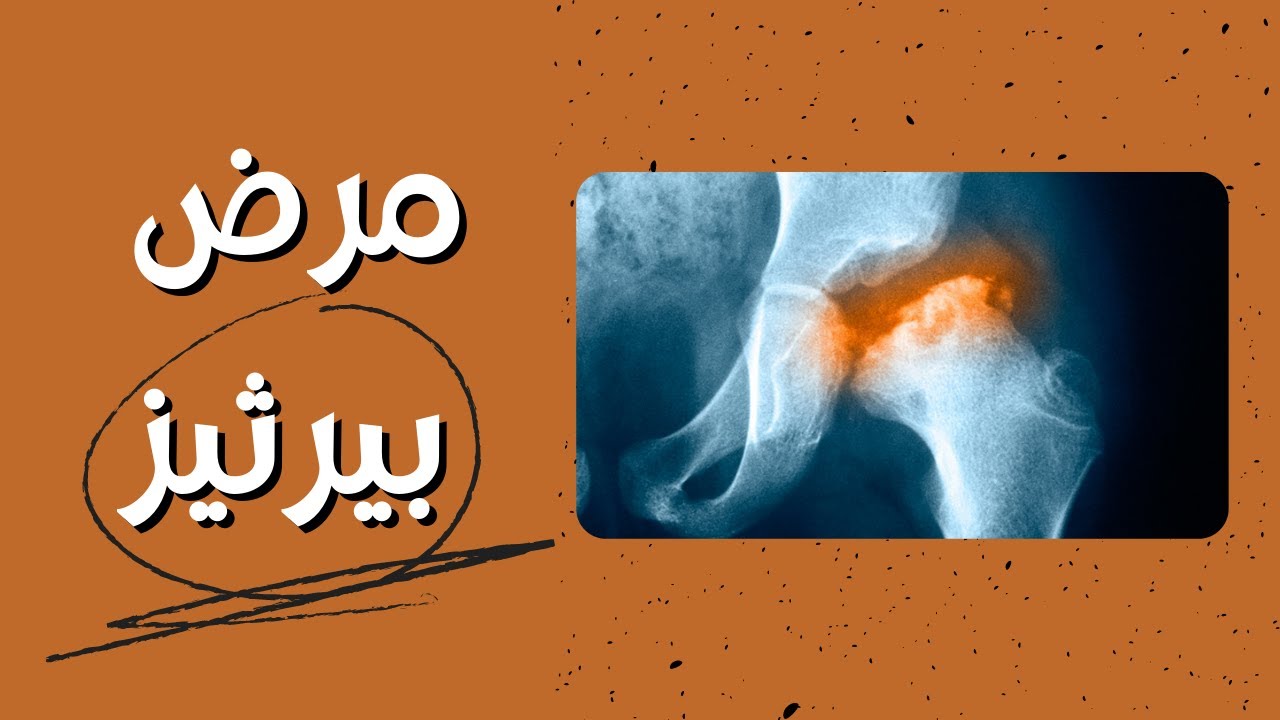 (نخر عظام الفخذ فى الاطفال)داء ليغ كالفيه بيرثيز - Perthes disease