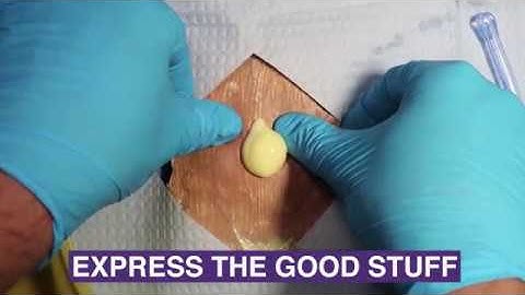 Incision and Drainage of Cutaneous Abscesses