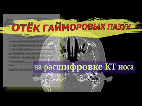 ОТЕК НОСА без насморка на РАСШИФРОВКЕ КТ носовых пазух. ОТЁК гайморовых пазух.