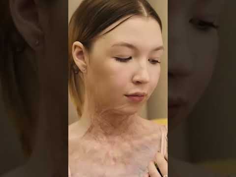 Ожоги 3-й степени на 20 тела