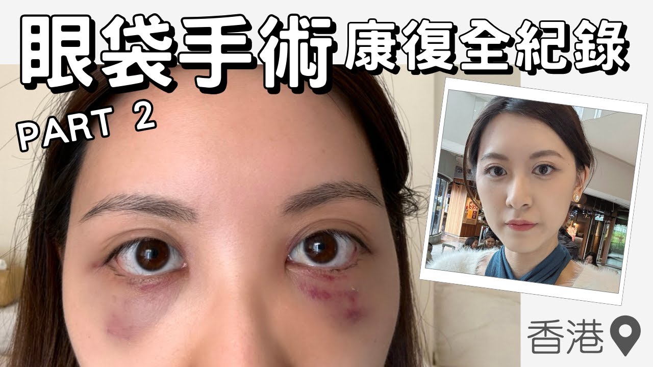 【眼袋手術Part 2】術後康復全紀錄 Day 5-29｜什麼時候消腫？黑眼圈會加深？