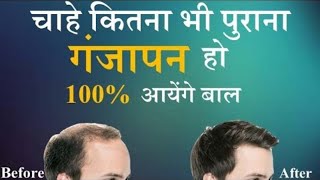 कितना भी पुराना हो गंजापन 100% आयेंगे बाल | देखिए Fact Check Shalini Kapoor के साथ | Onion Juice