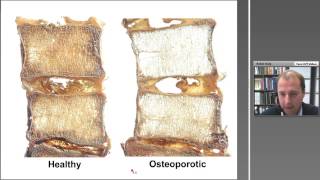 Osteoporosis and Exercise