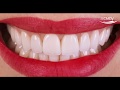 Um sorriso perfeito - Facetas dentárias