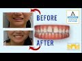 Invisalign Before and After: Gap in Teeth