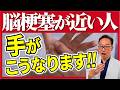 知らないと怖い！手のサインでわかる脳梗塞の前兆5選