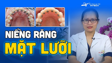 Những Điều Cần Biết Khi Chọn Niềng Răng Mắc Cài Mặt Lưỡi | Niềng Răng Mặt Trong Là Gì