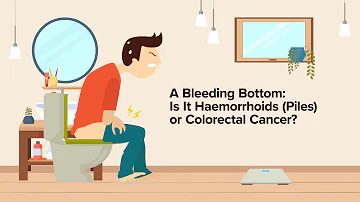 The Bleeding Bottom: Is It Piles or Colorectal Cancer?