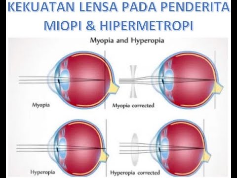 hipermetropie în miop