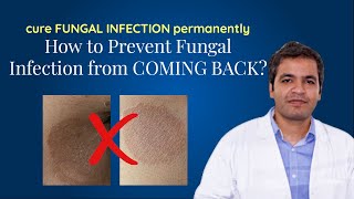 Resistant Fungal Infection: How to cure FUNGAL INFECTION permanently