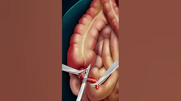 عملية استئصال الزائد الدودية Appendectomy Appendectomy جراحة الكولون عمليات جراحية طبيب جراحة 