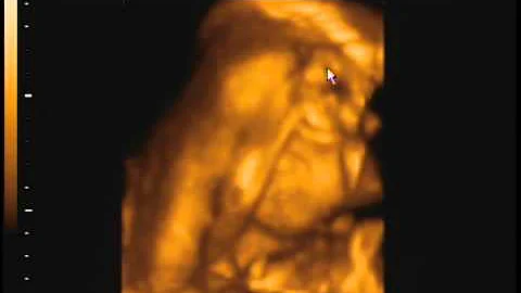 25 Wk Ultrasound Of Sienna Grace Zabala