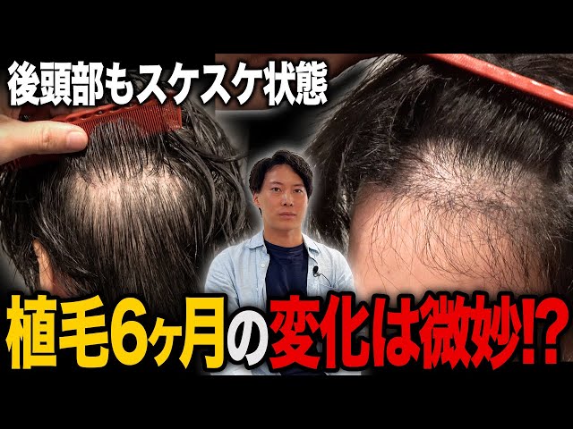 Tragedy] Even after 6 months of hair transplant, the