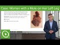 Derma Case: 38-year-old Woman with a Mole on Her Left Leg -- Dermatology | Lecturio