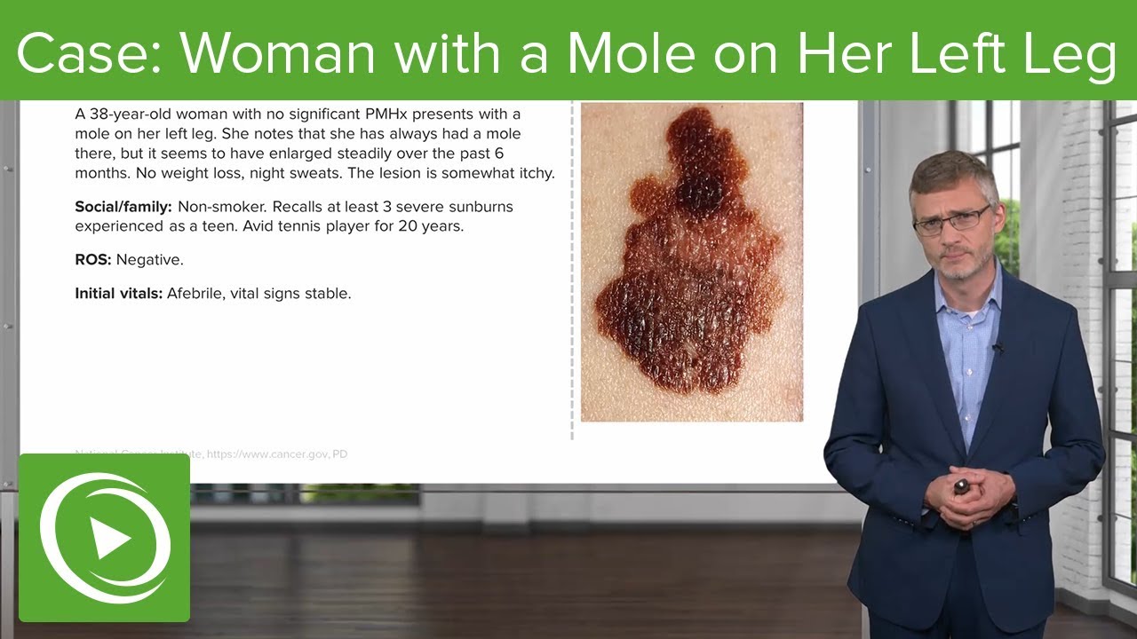 Derma Case: 38-year-old Woman with a Mole on Her Left Leg ...