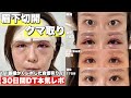 【美容整形】眉下切開とクマ取りDT30日間！誰よりも細かくレポ！~30代のアンチエイジング~同じ悩み抱えてる人向け🍀
