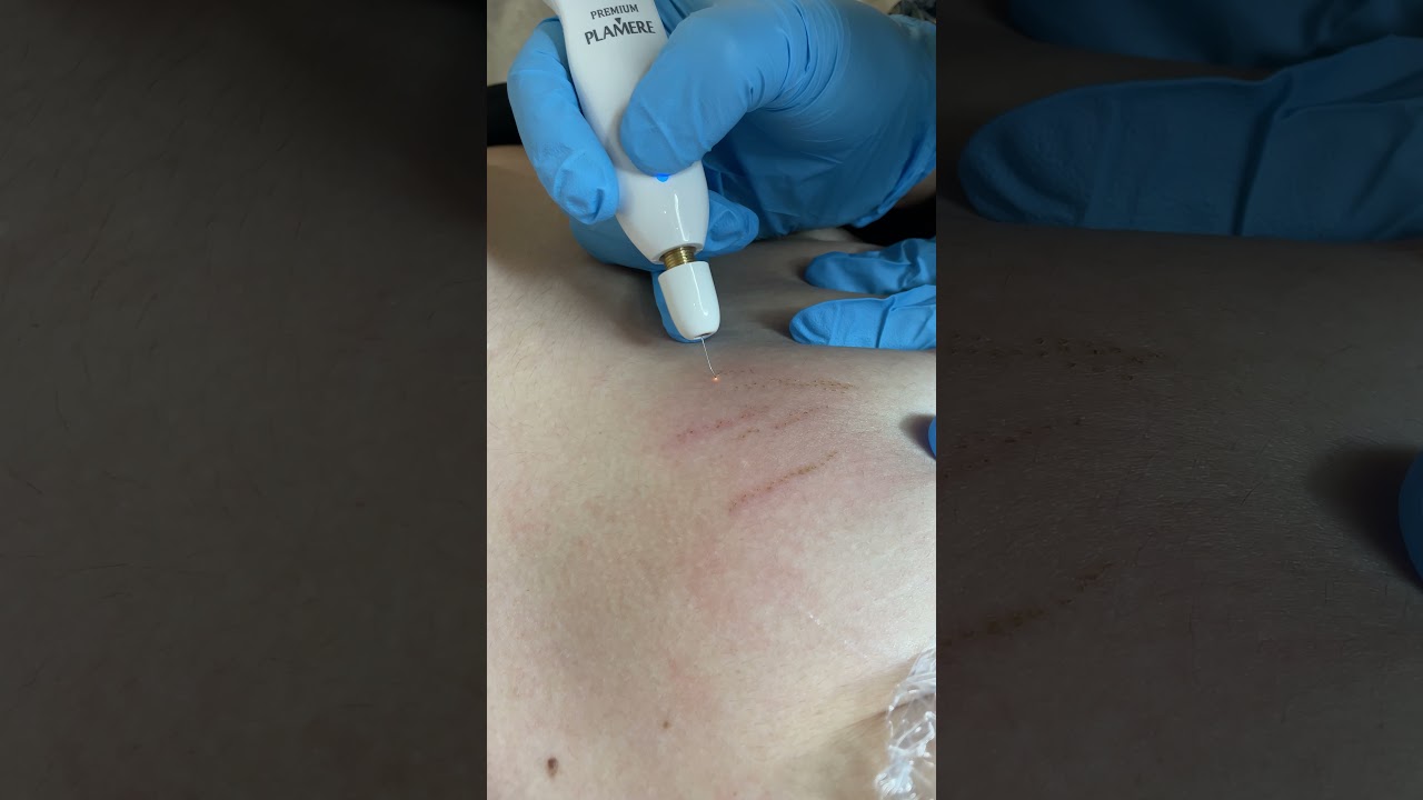 Fibroblast Plasma Pen Treatment for Stretch Marks