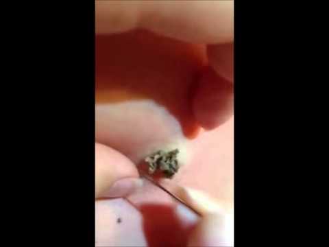 Blackheads Best Blackhead Removal Pimple Popping 2015 - YouTube