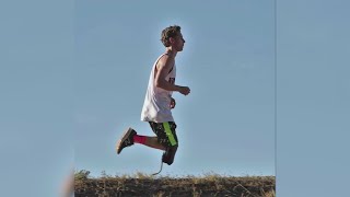 Teen with amputated leg shares story of cancer survival