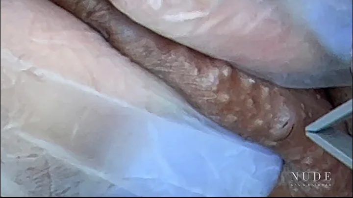 Ingrown hair Extractions Episode 9