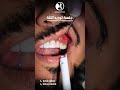 جلسة توريد اللثة نتيجة رائعة