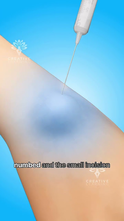 How Ganglion Cyst Removal Surgery Works #shorts #viralvideo - Creativelearning3d