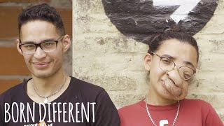 My Facial Tumour Hasnt Stopped Me Finding Love Born Different