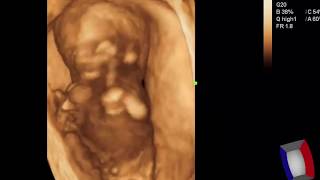 Case 373 2D 3D 4D Fetal Phocomelia Meromelia