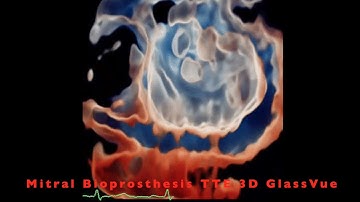 Mitral Bioprosthesis: TTE 3D GlassVue, TrueVue