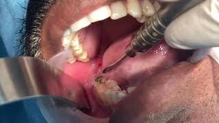Mesioangular impacted wisdom tooth removal - Third molar extraction under local anesthesia video