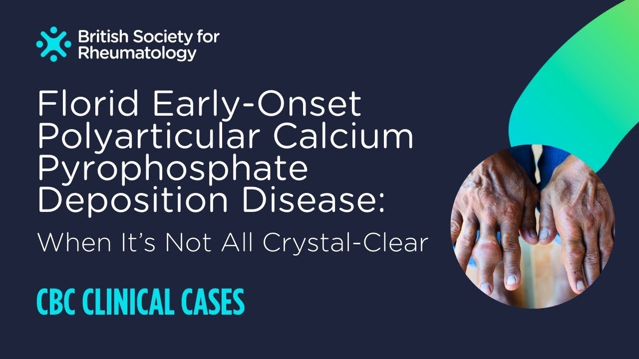 Florid Early-Onset Polyarticular Calcium Pyrophosphate Deposition Disease | Case-Based Conference