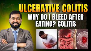 Ulcerative Colitis Recovery – You Won’t Believe How | Dr Haque