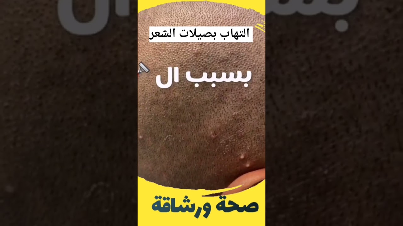 التهاب بصيلات الشعر - 1 -  د. أنور الحمادي