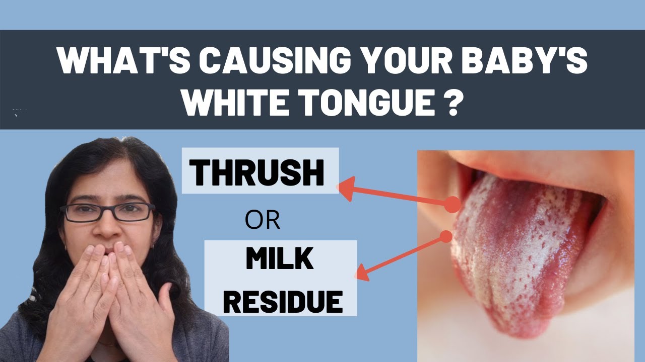 Thrush Vs Milk Tongue: How To Tell The Difference | eduaspirant.com