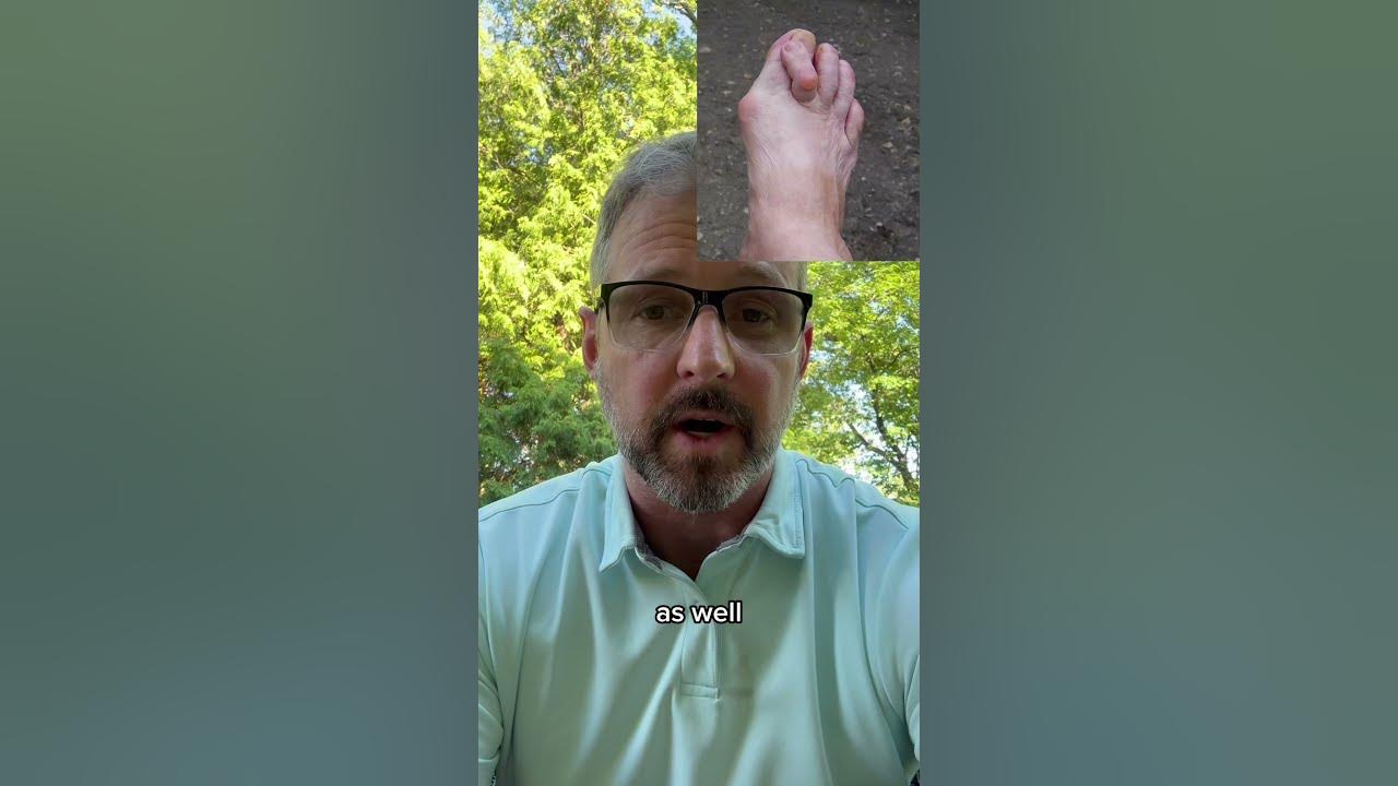 2-reasons-to-get-your-bunion-fixed-even-if-it-doesn-t-hurt-bunions