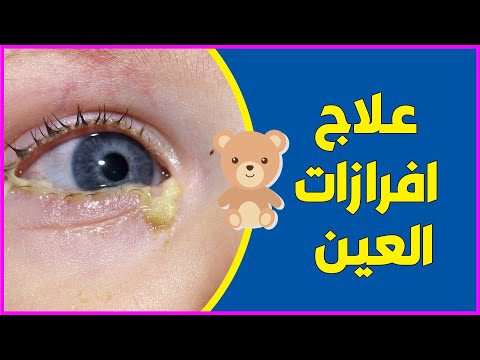 علاج انسداد القنوات الدمعية وعلاج افرازات العين عند الاطفال والرضع   (شوفوا الفيديو للاخر)