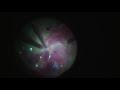 Removing pre retinal haemorrhage after surgery for pdr