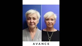 Before And After Mini Facelift/Neck Lift & CO2 Laser Resurfacing | Avance Plastic Surgery Institute