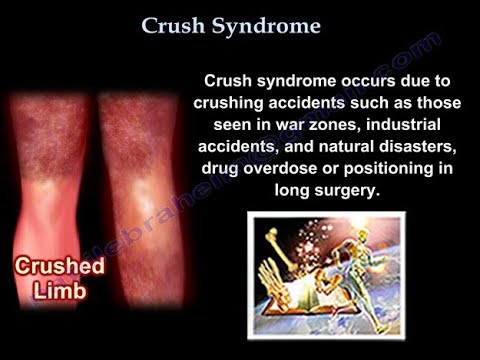 Crush Syndrome - Everything You Need To Know - Dr. Nabil Ebraheim ...