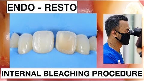 Internal Bleaching Teeth Discoloration + Direct Restoration | General Dentist Griya RR