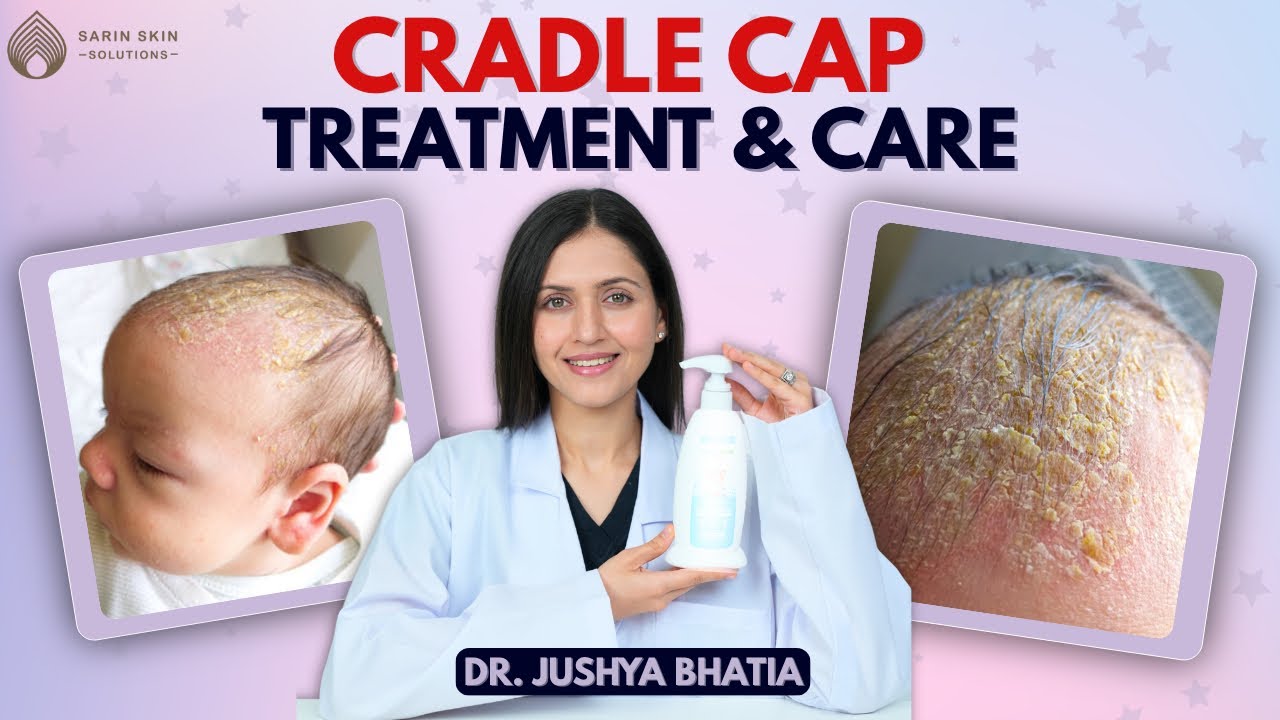 How to Treat Cradle Cap Safely | Baby Scalp Care Explained || Dr. Sarin ||