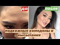 КАК Я ИЗБАВИЛАСЬ ОТ ПРЫЩЕЙ|подкожные прыщи и закрытые комедоны