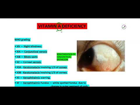 Vitamin A Deficiency Who Grading And Treatment Youtube