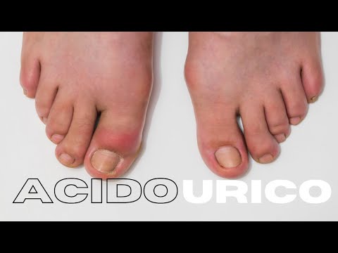 No hagas esto si tienes ACIDO URICO