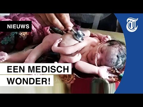 Video: Een Jongen Werd In India Geboren Met Vier Poten En Een Dubbele Set Geslachtsdelen - Alternatieve Mening