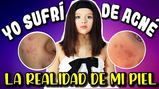 😓 YO SUFRI DE ACNE 😓 | REVELO mi INSEGURIDAD más GRANDE